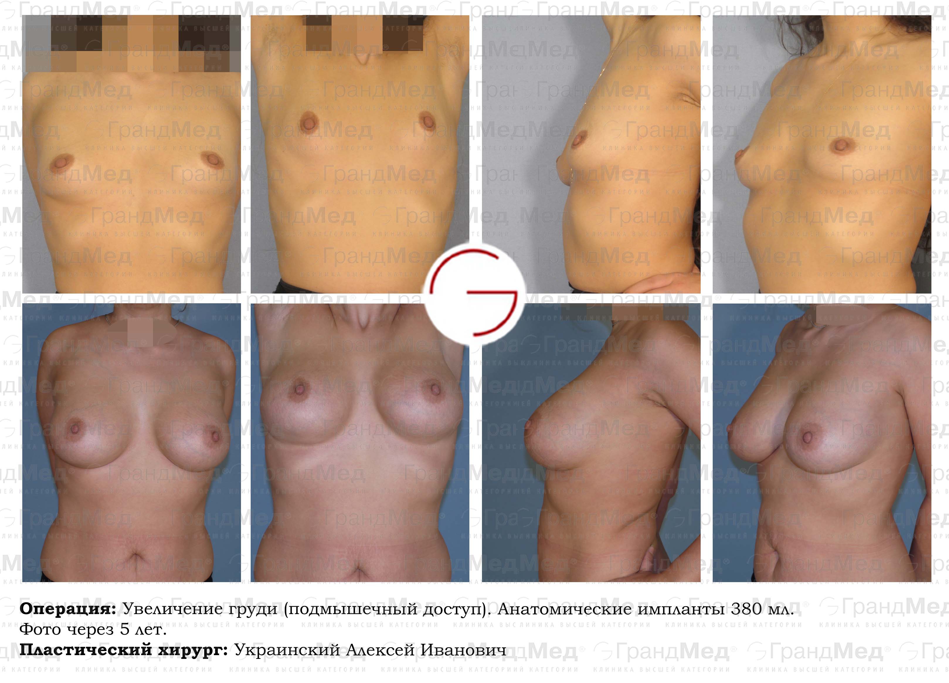 как увеличить одну грудь без операции фото 64