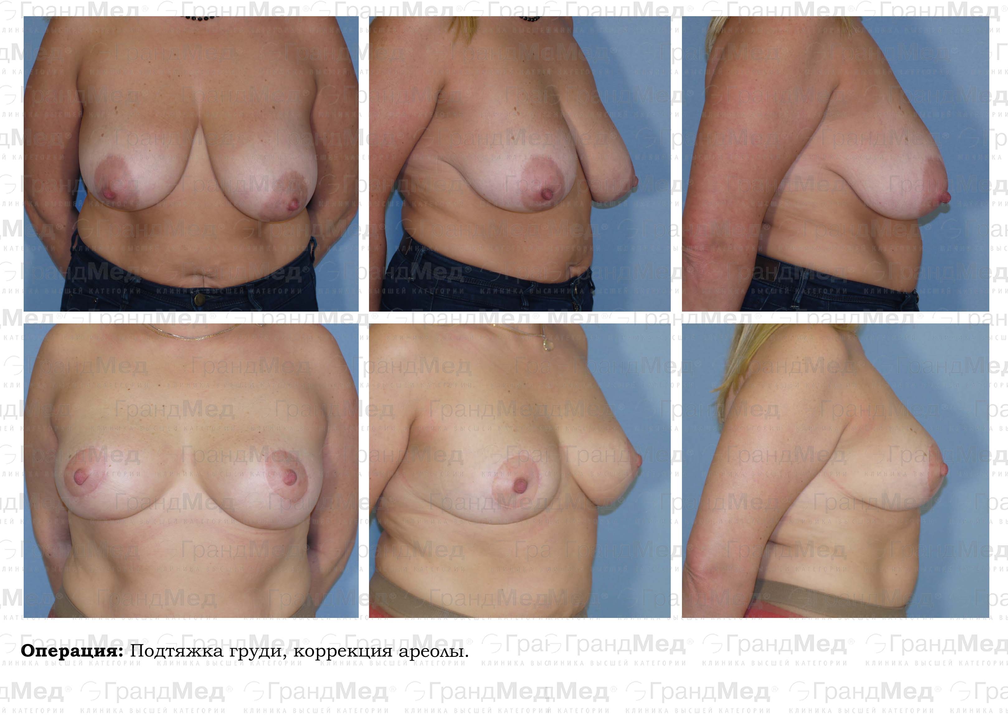операция по подтяжке груди у женщин фото 105