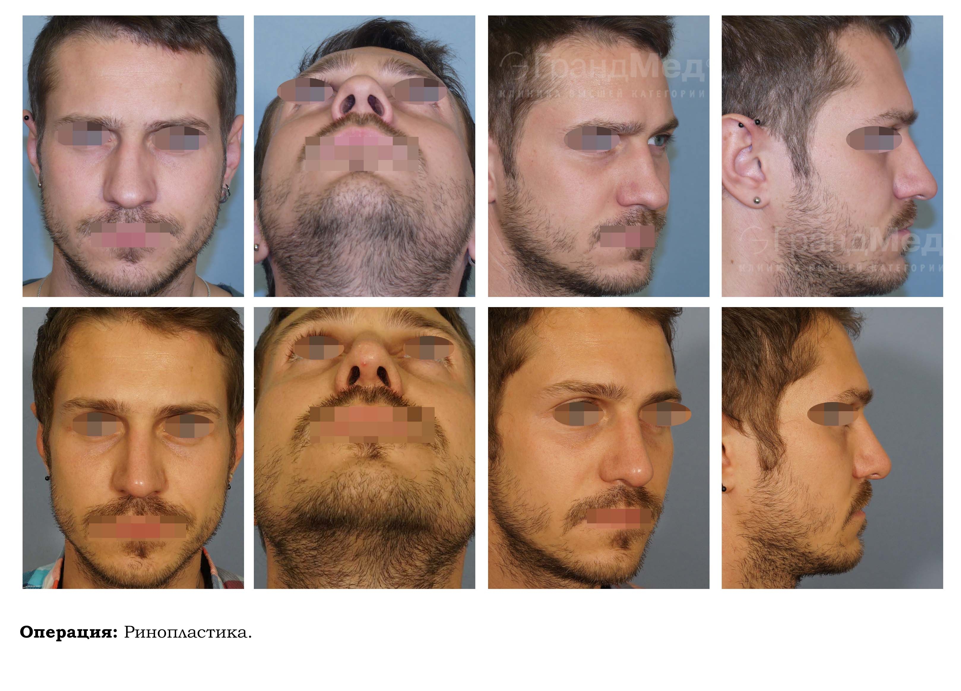 Как мужчине увеличить орган. Ринопластика до и после мужчины. Мужская ринопластика носа. Ринопластика носа мужчины до и после.