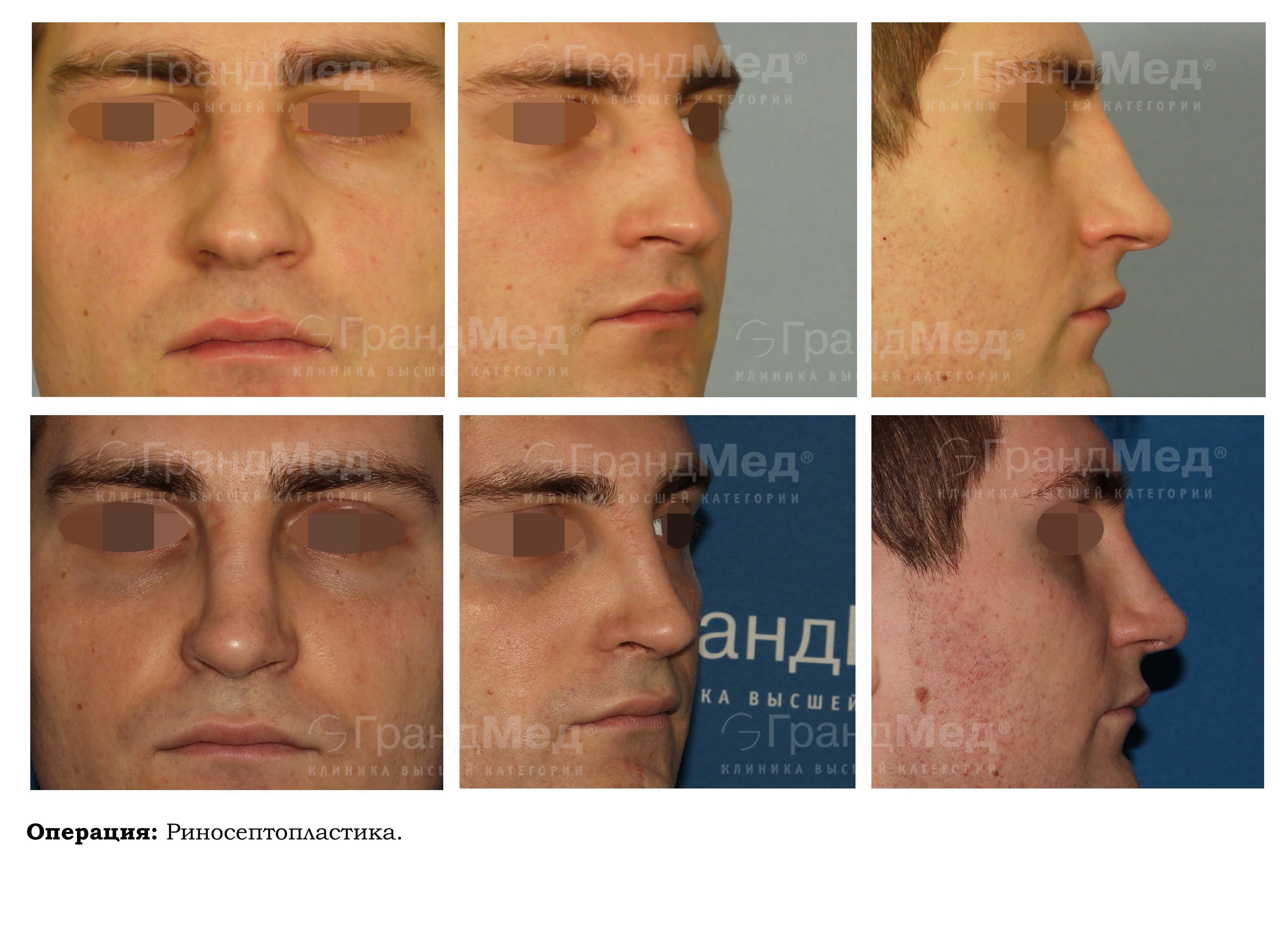 Операция носовой перегородки по омс. Риносептопластика у мужчин. Повторная риносептопластика. Риносептопластика у мужчин фото. Мужская риносептопластика хирурги.