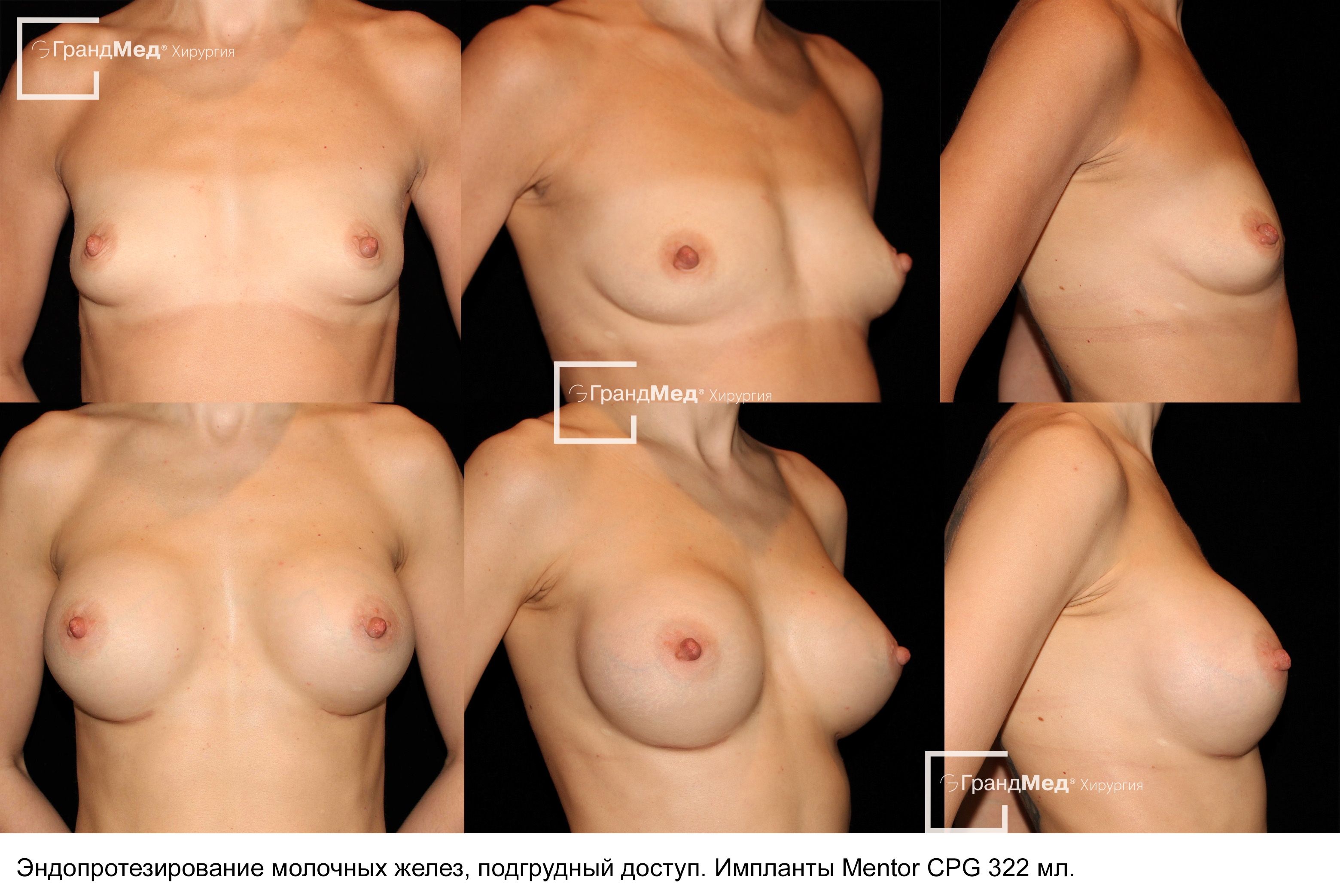 асимметрия груди у мужчин фото 53