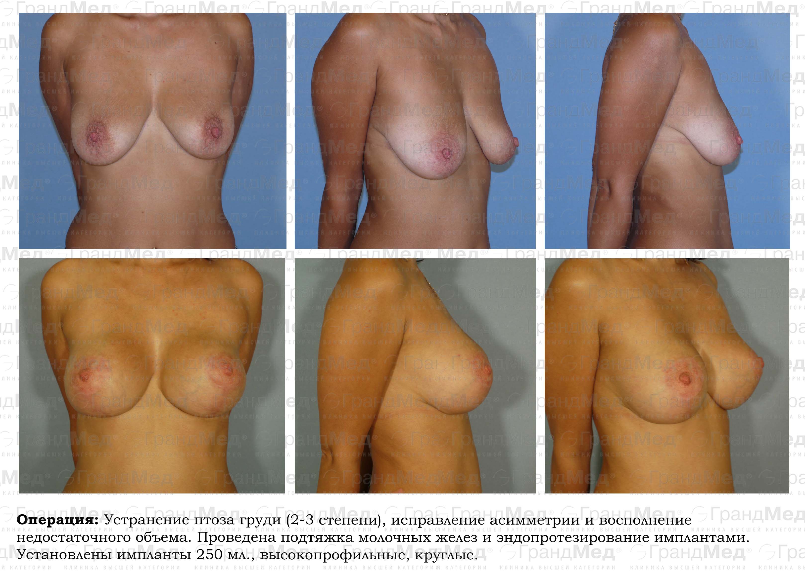 операция на груди у женщин фото 117