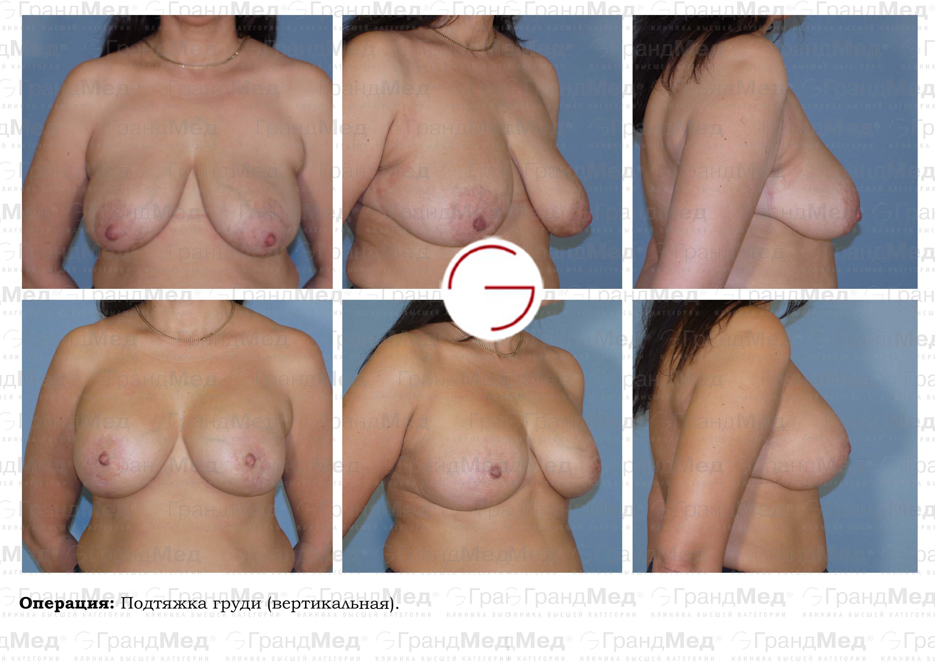увеличилась одна грудь во время менструации фото 108