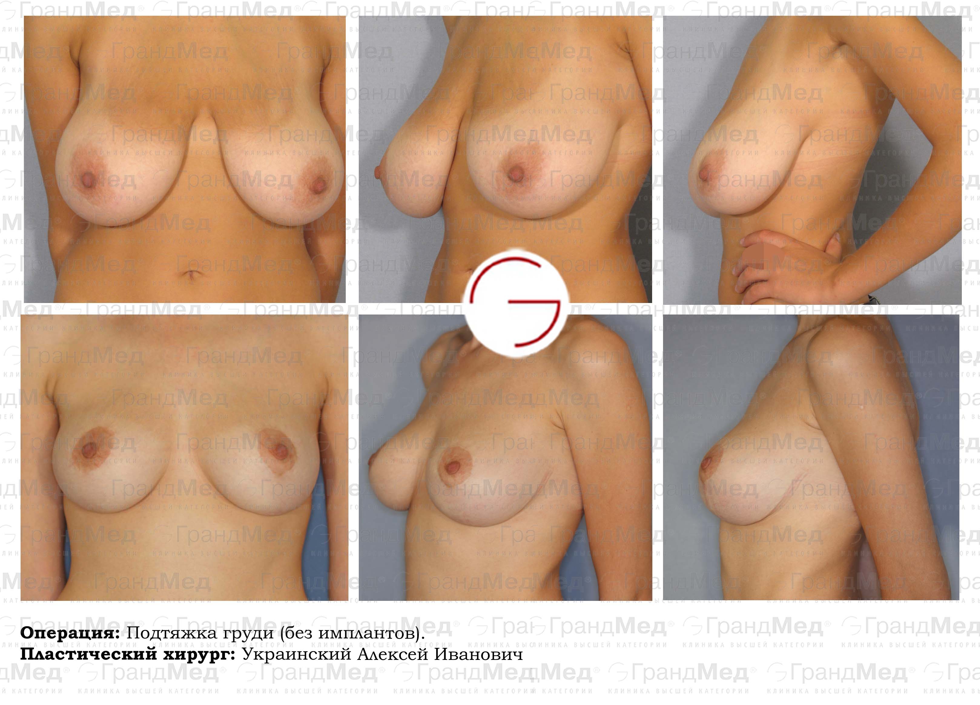 уменьшение груди у женщин фото 99