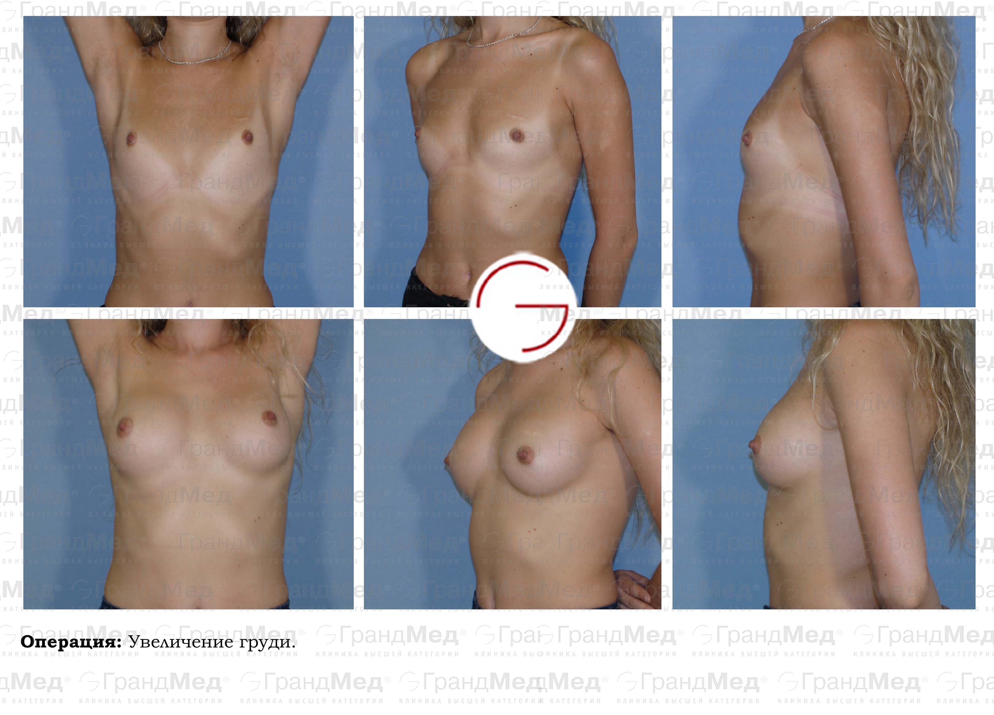 увеличивается грудь с возрастом у женщин фото 112