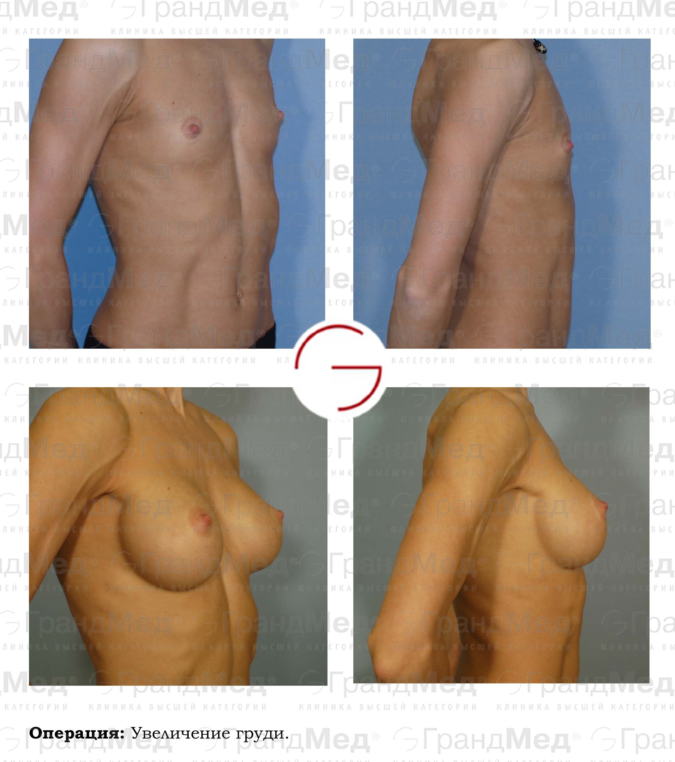 как женщин делают операцию на груди фото 105
