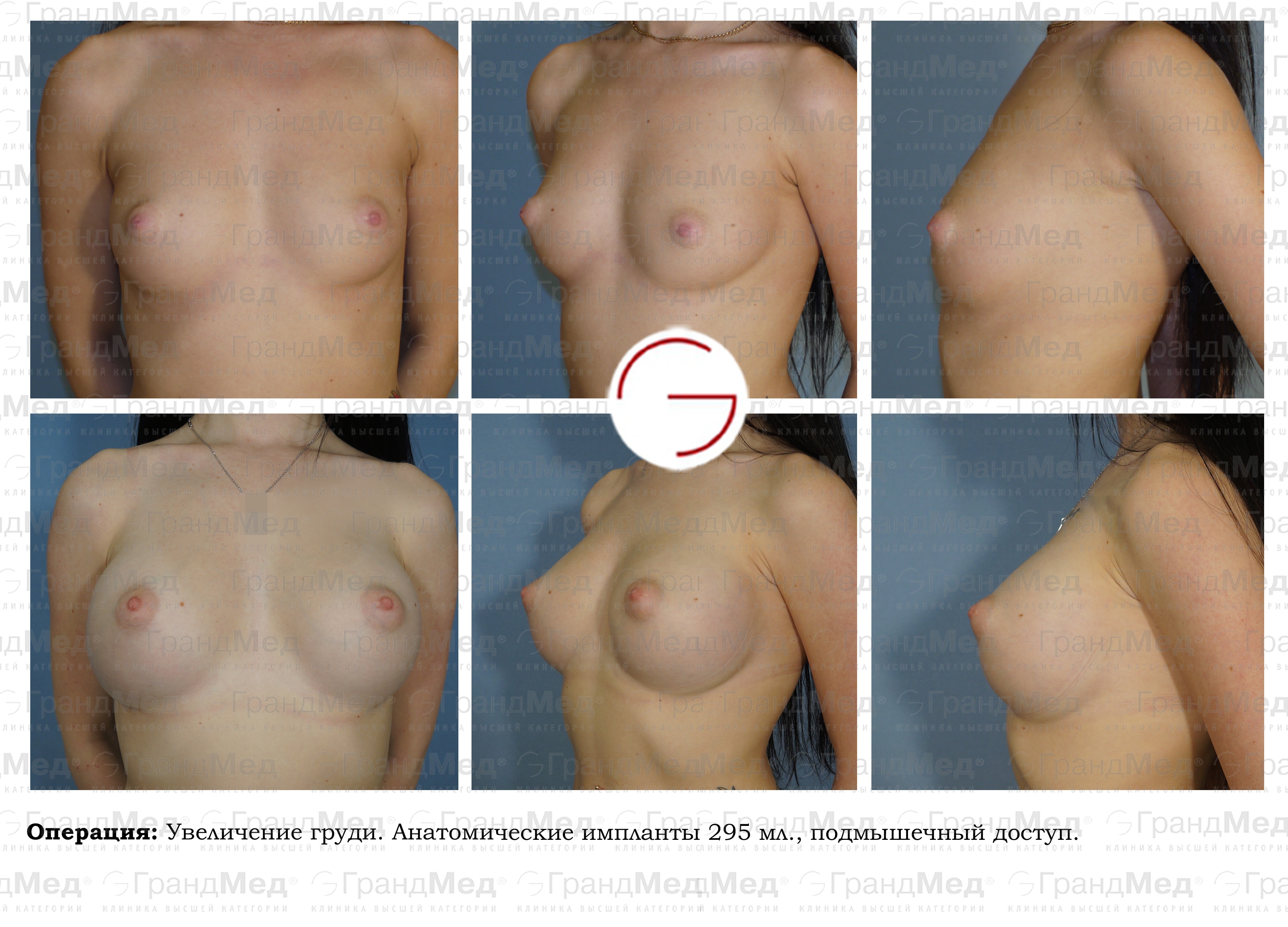 силиконовая грудь круглые импланты фото 35